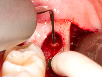 Piezomed P1 Piezomed P1