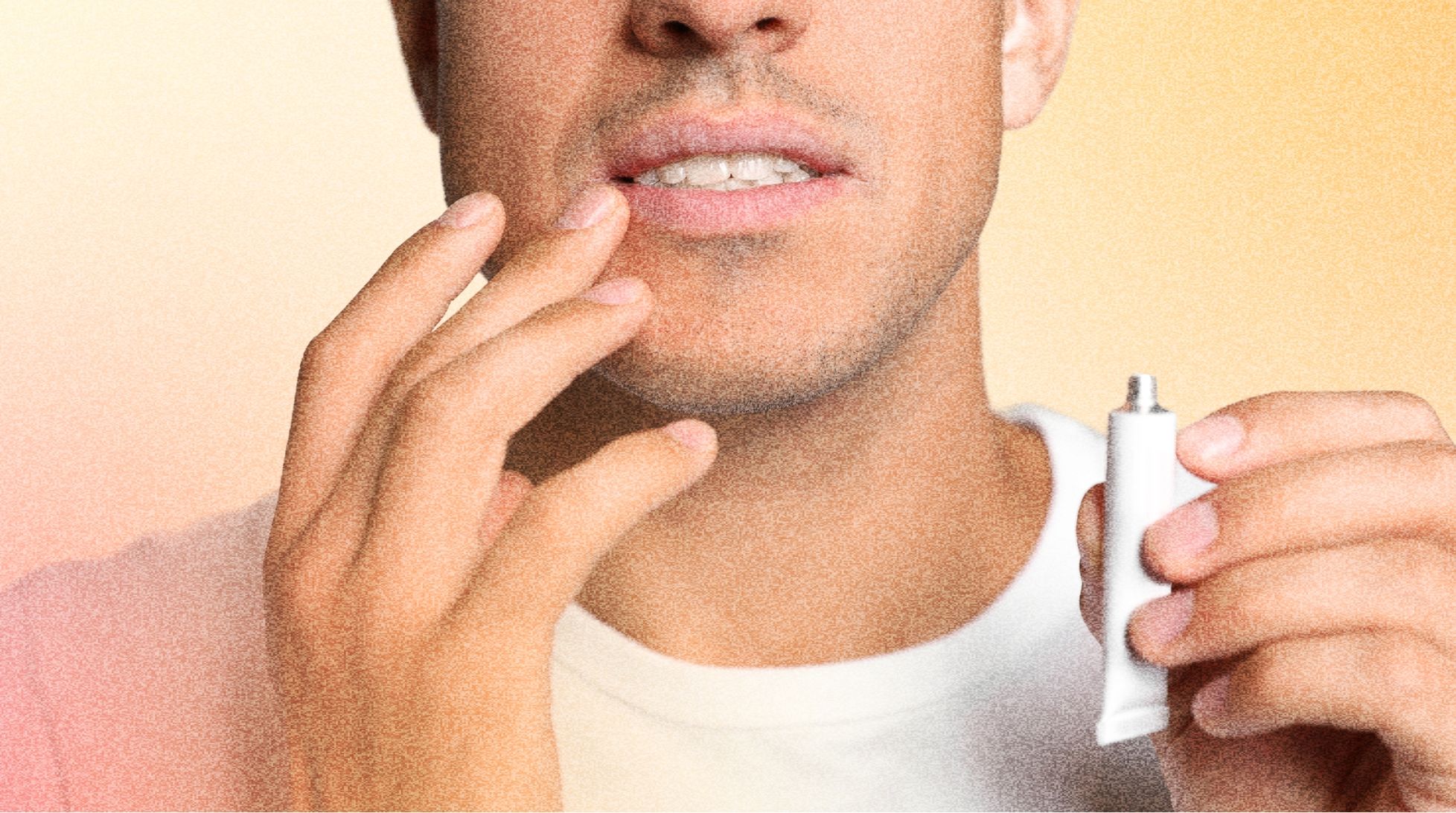 Профилактика герпеса: как избежать повторных вспышек