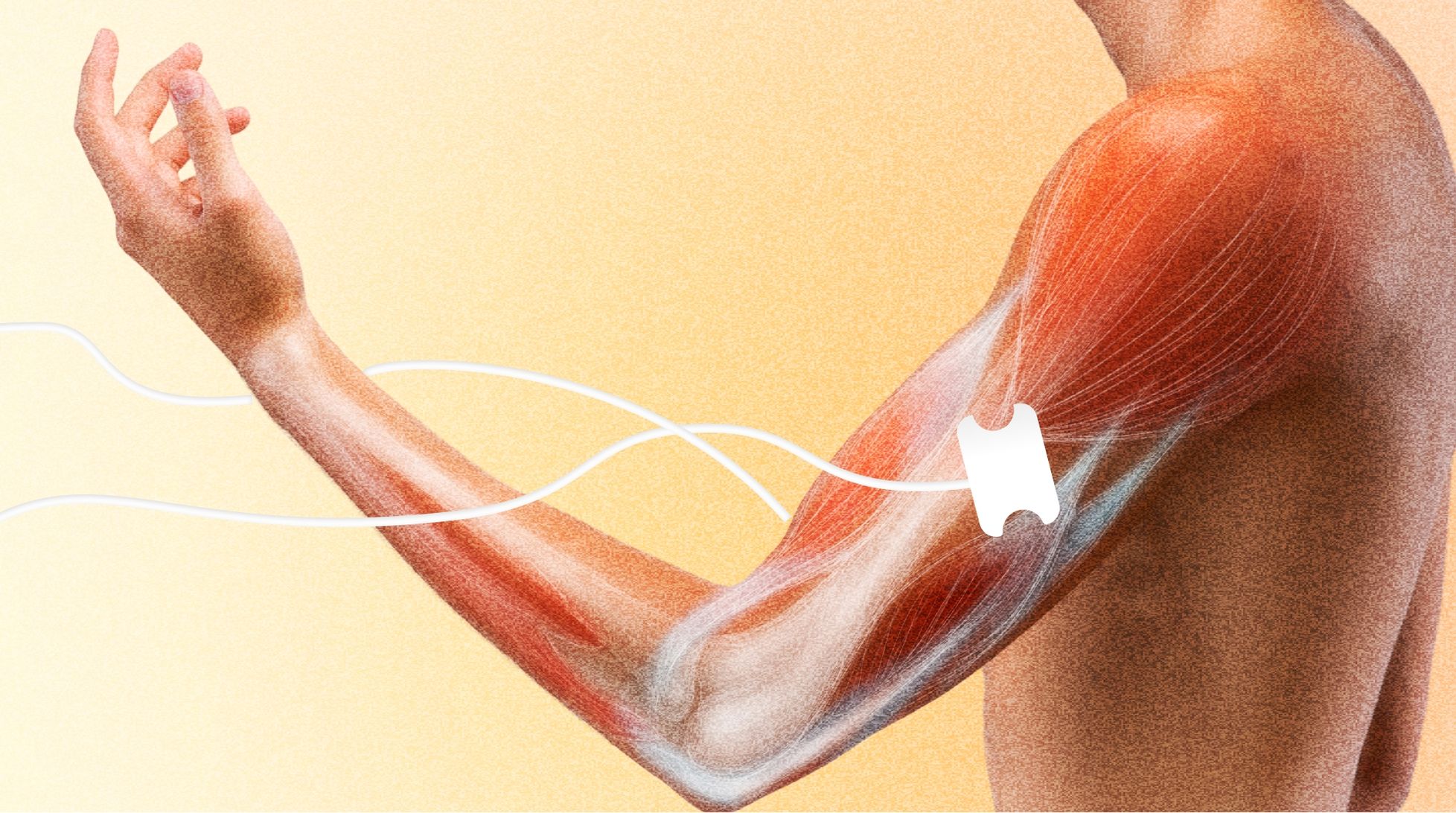 Что такое электронейромиография (ЭНМГ) и когда она необходима?