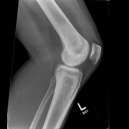 Knee bones