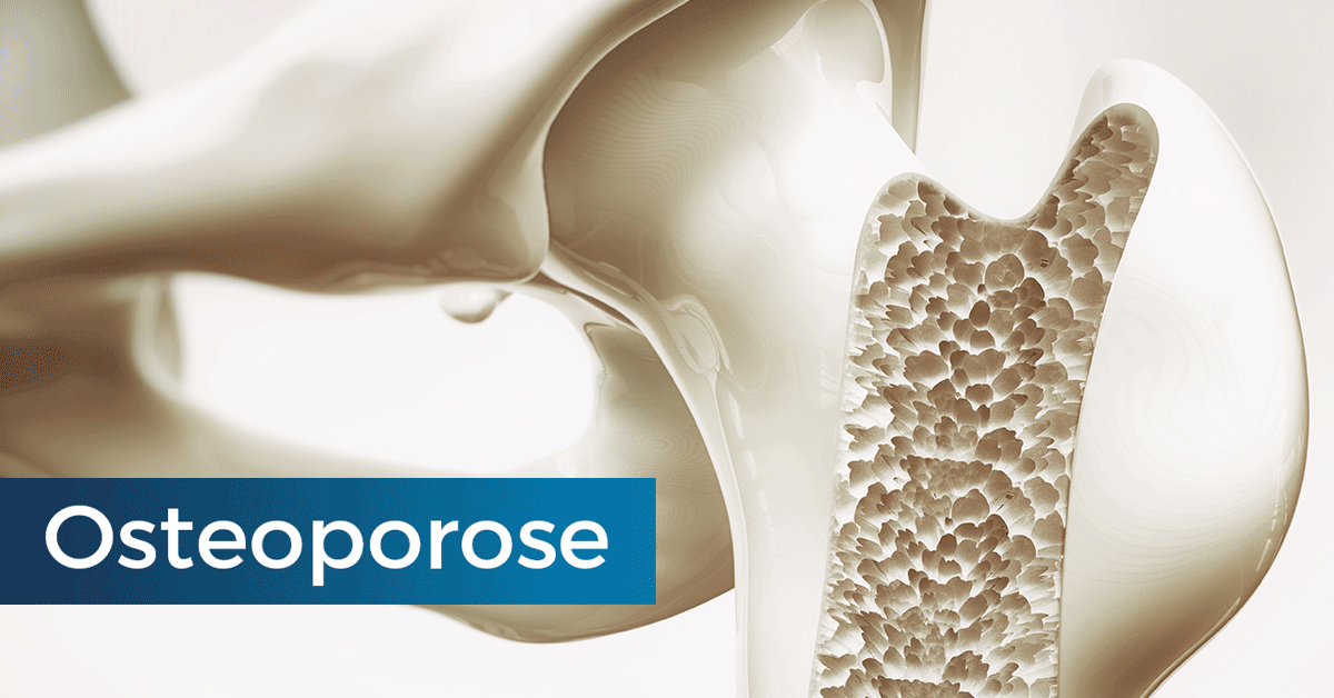 Osteoporose (Knochenschwund)