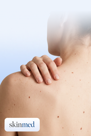 melanoma