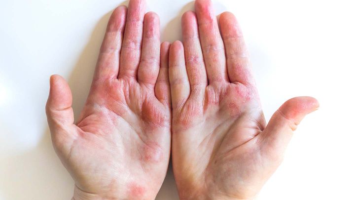 Eczeem is een huidaandoening die voor jeuk zorgt.