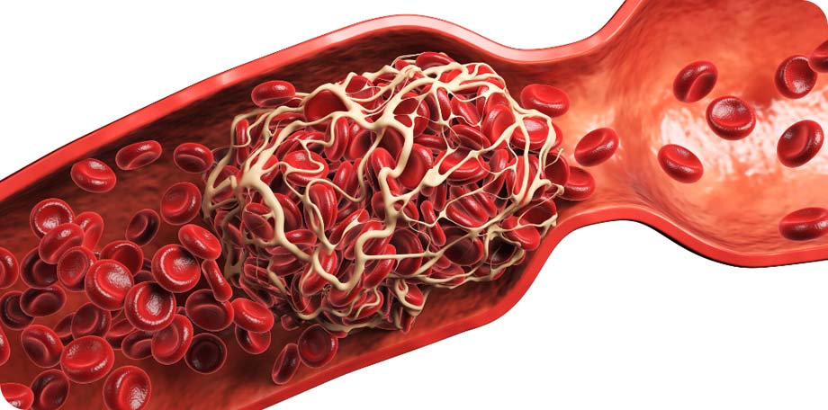 Eliquis behoort tot de directe orale anticoagulantia (DOAC’s)