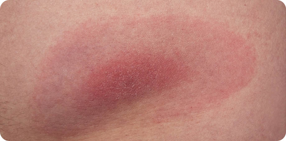 Een rode kring is vaak een eerste teken van de ziekte van Lyme.