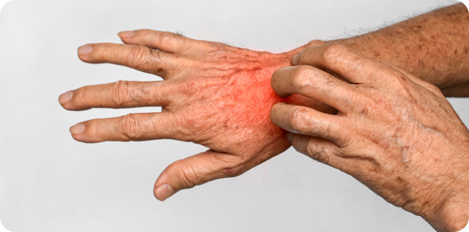 Wat te doen bij schurft? Herken de symtomen en onderneem actie als je deze aandoening denkt te hebben opgelopen.