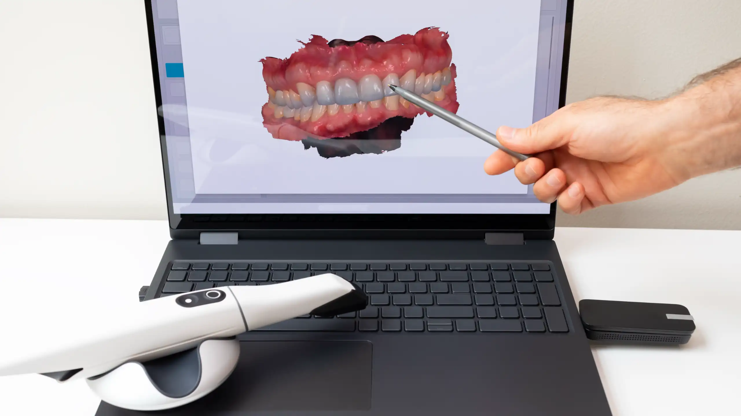 A dental 3D scan displayed on a laptop screen, with a hand pointing at it using a stylus and a scanner resting on the keyboard.