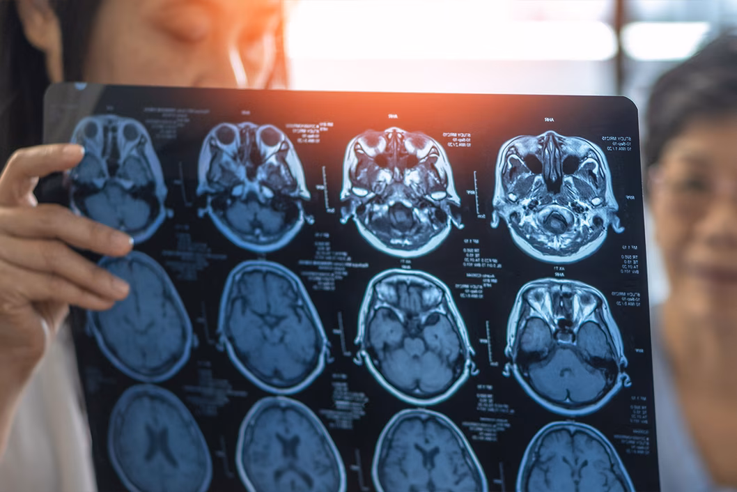 Photo of health workers looking at an Xray scan of a human brain