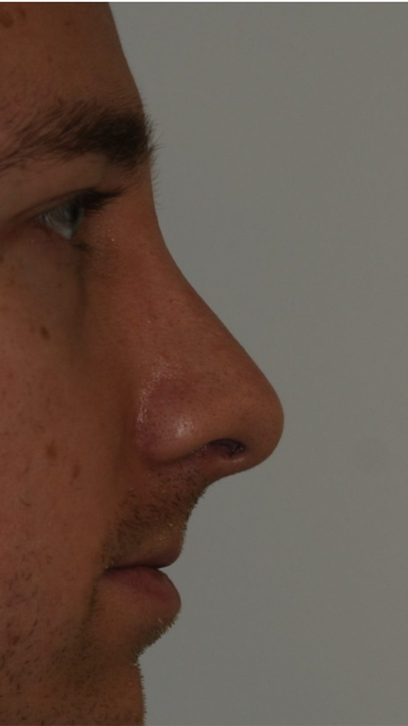 Rhinoplasty