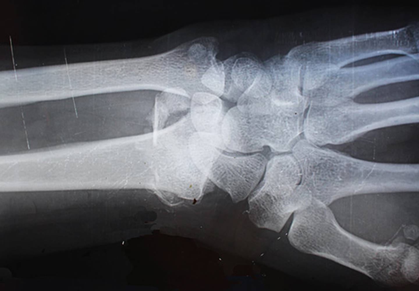 block header personal injury