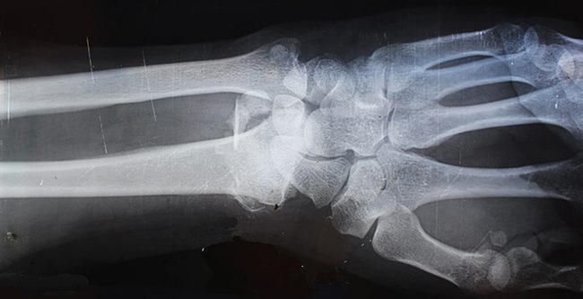 block header personal injury