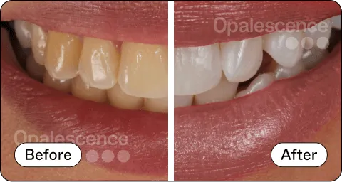 Opalescence Pro Before and After