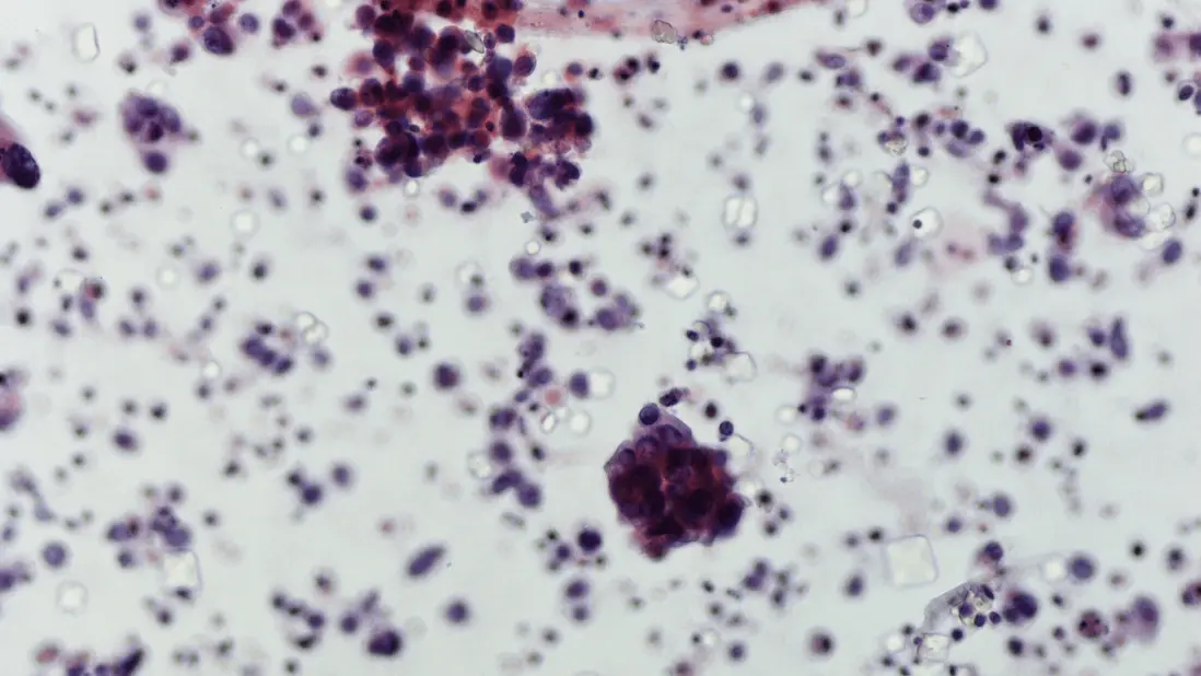 Enabling innovative accurate diagnostics for early bladder cancer detection