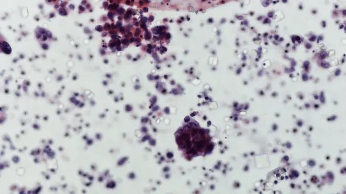 Enabling innovative accurate diagnostics for early bladder cancer detection