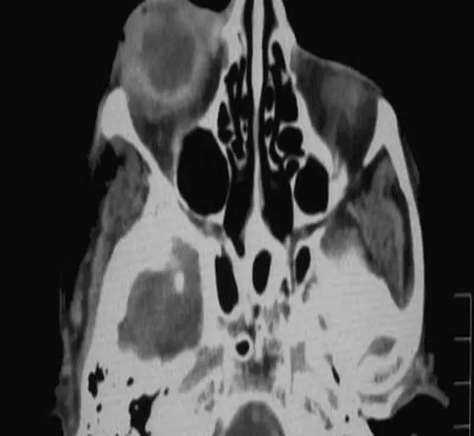 Accelerating retinal disease detection at low cost