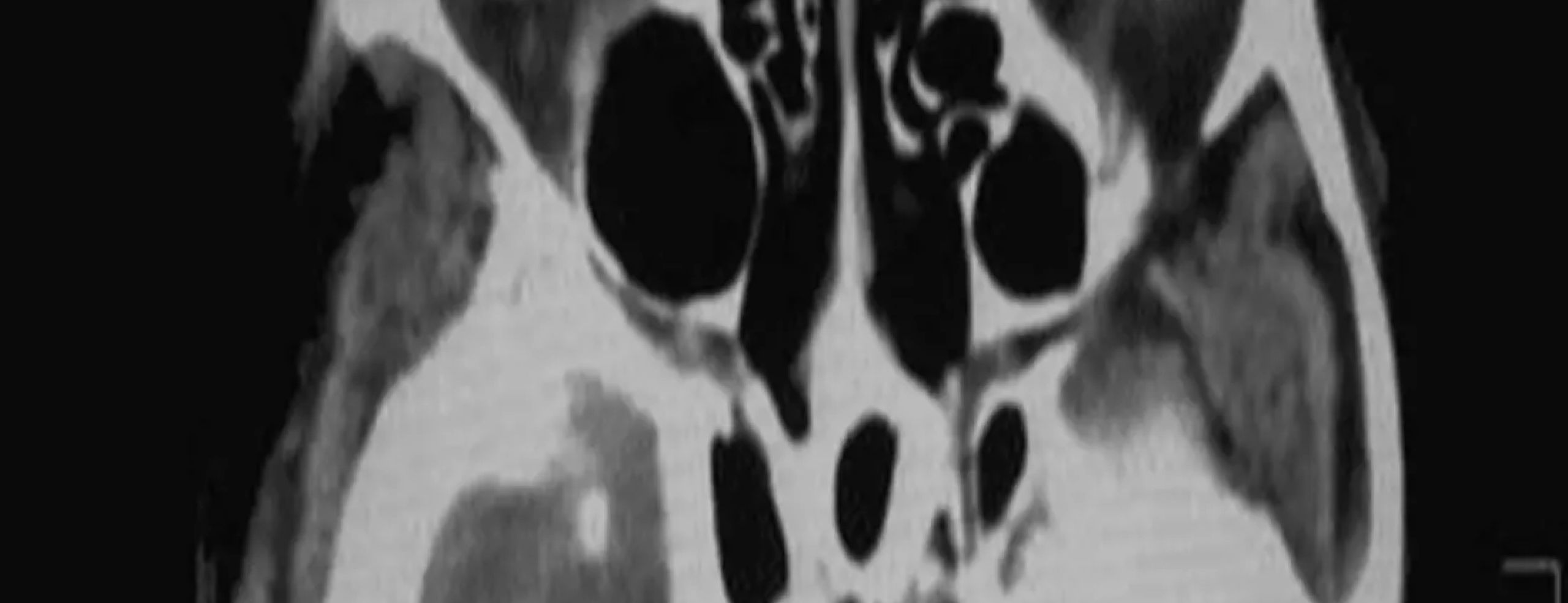 Healthcare - Accelerating retinal disease detection at low cost