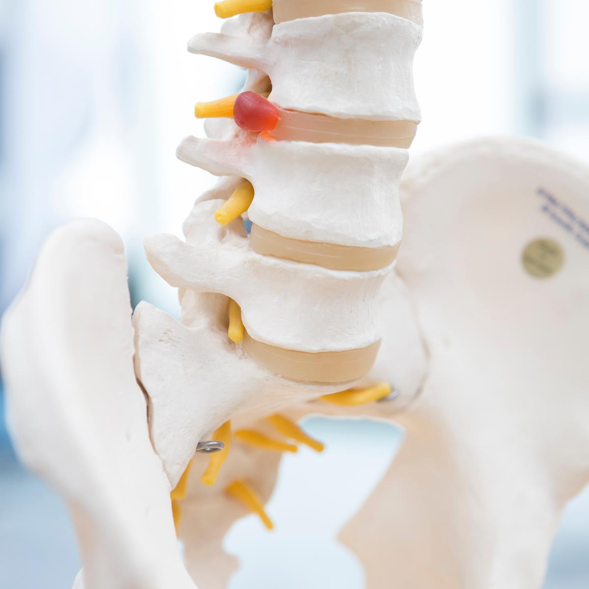 Wat na een lumbale discus hernia? Evidence based kinesitherapie
