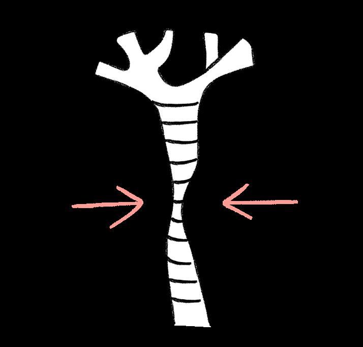 A line drawing diagram of a trachea with pink arrows indicating the direction of collapse