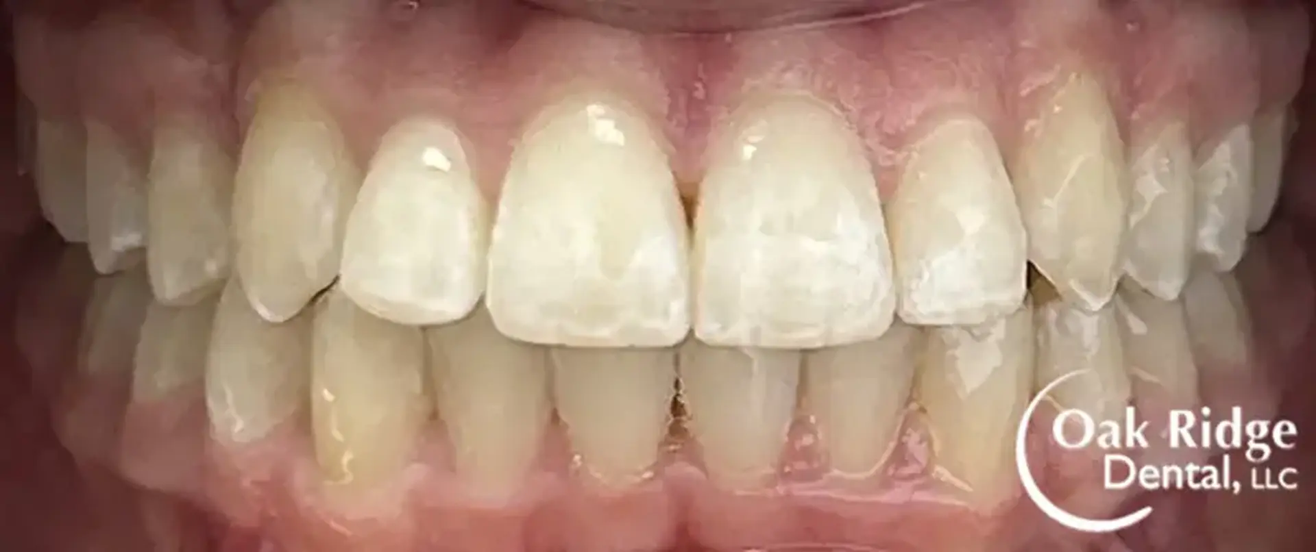 A closeup view of a patient's teeth after Invisalign treatment