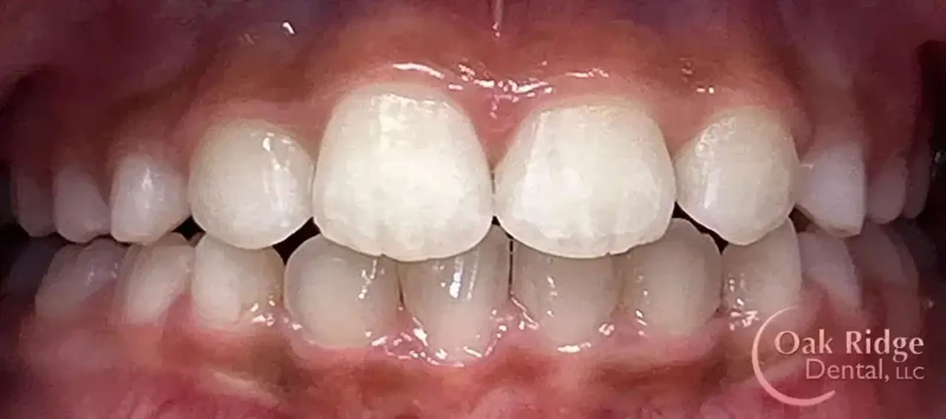 A closeup view of a patient's teeth after Invisalign treatment
