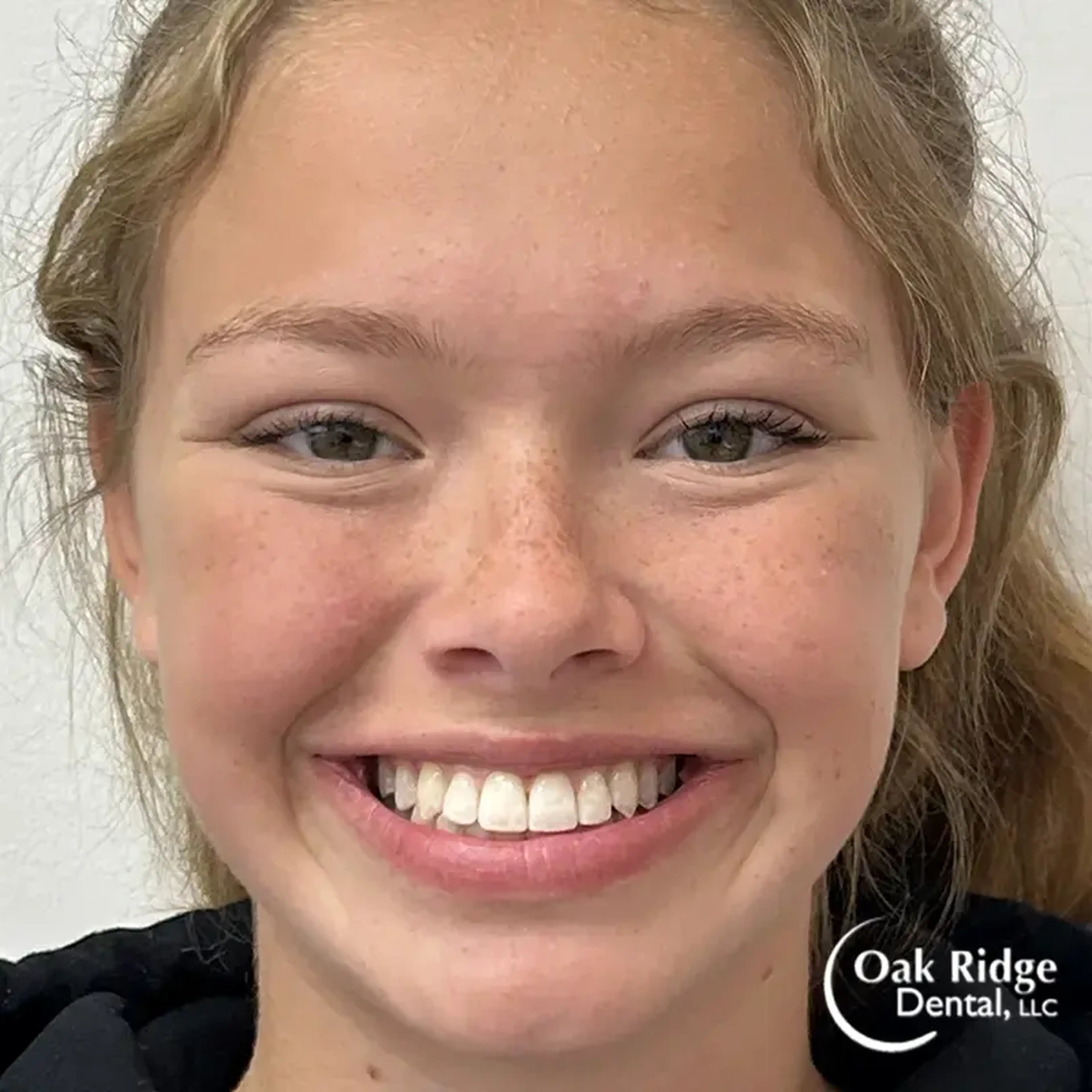 A young woman after Invisalign treatment