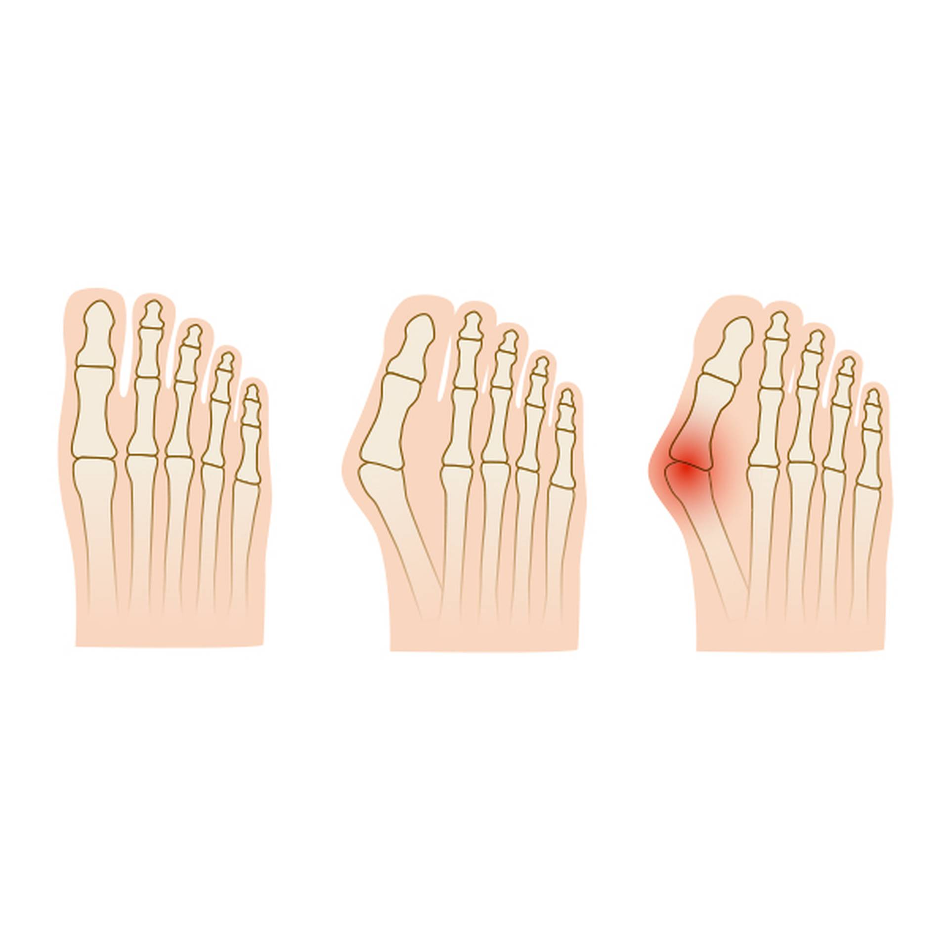 Hallux Valgus Skelett