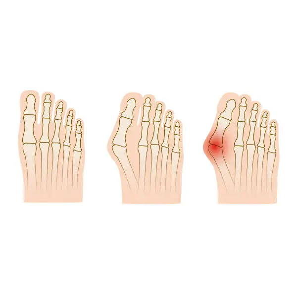 Hallux Valgus Skelett