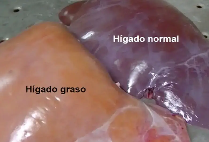 higado-graso