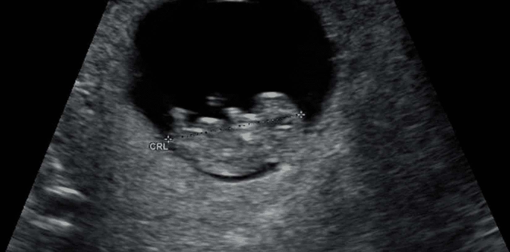 An early pregnancy scan, a very small outline of a baby can be seen in black and white