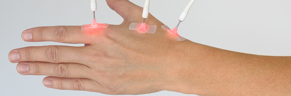 Laserakupunktur an der Hand mit gezielter Lichtanwendung auf Akupunkturpunkte.
