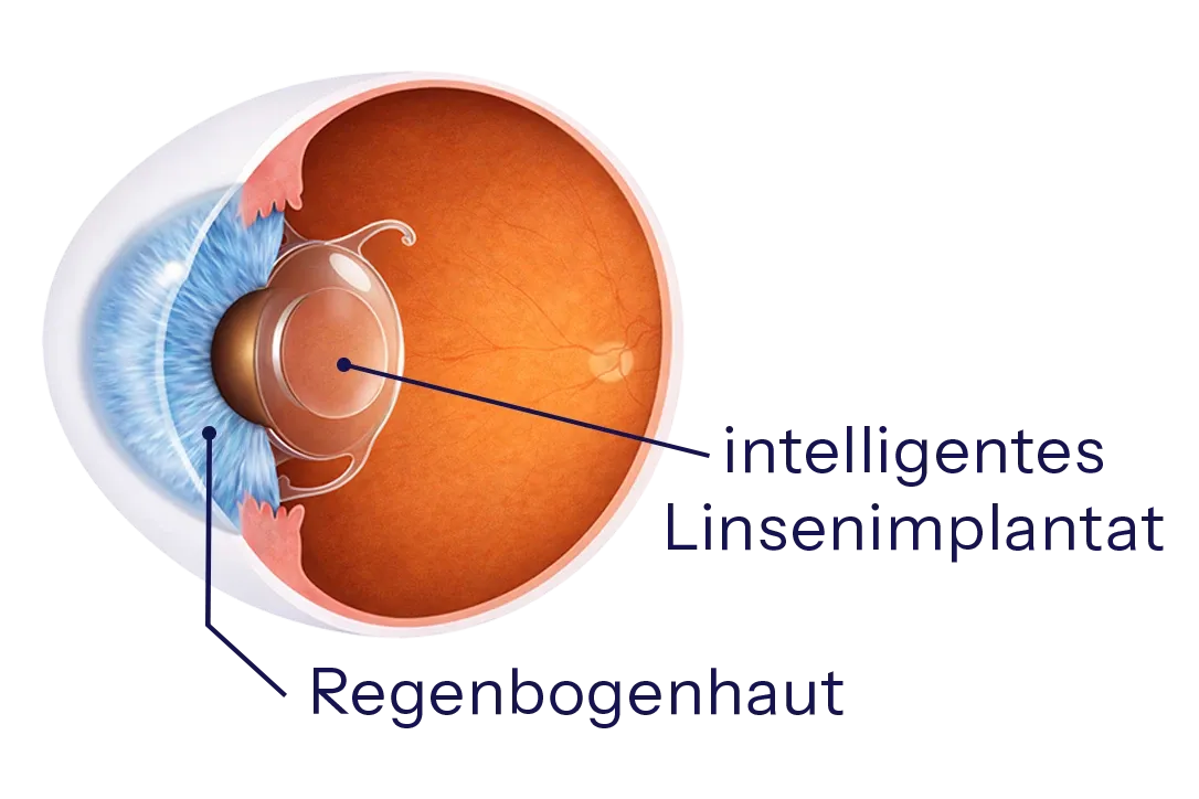 Skizze eines Auges mit Linsenimplantat beim refraktiven Linsenaustausch – Linsenimplantation zur Korrektur der Sehkraft.