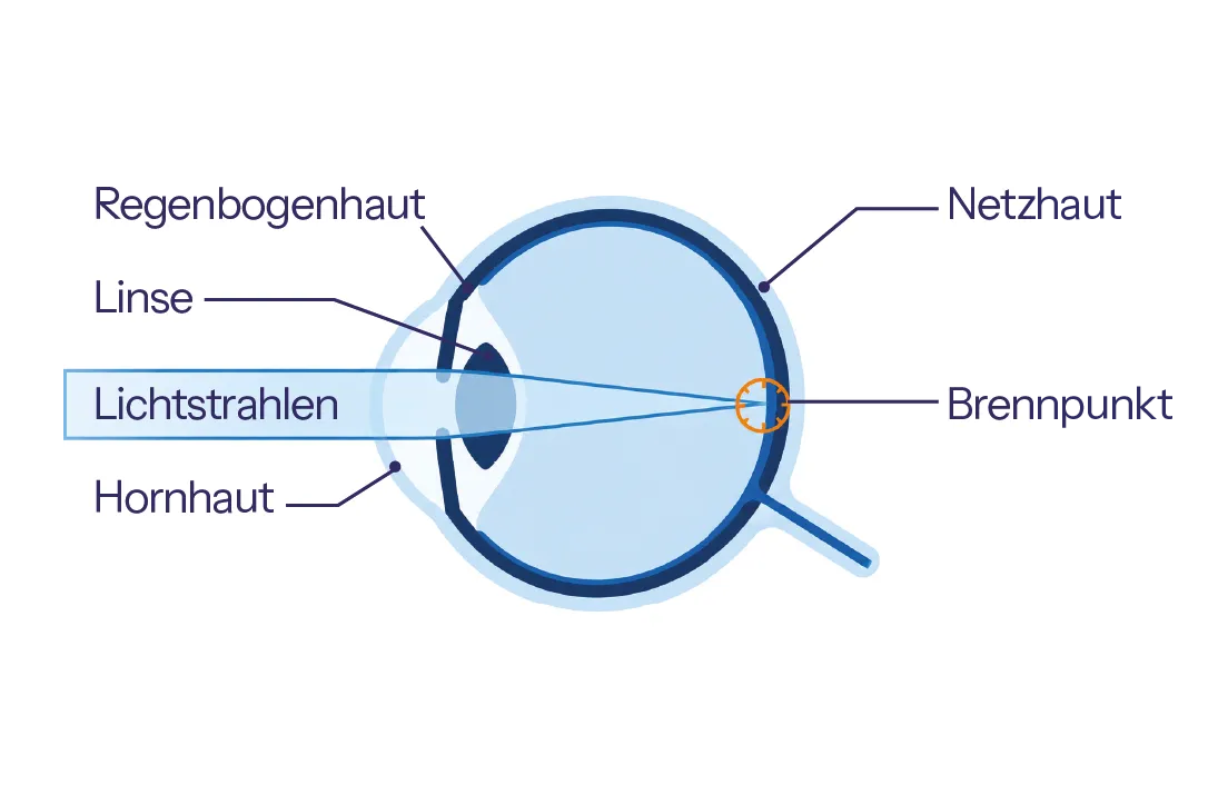 Schematische Darstellung der korrigierten Weitsichtigkeit: Einfallende Lichtstrahlen bündeln sich auf der Netzhaut. (KI-generiert)