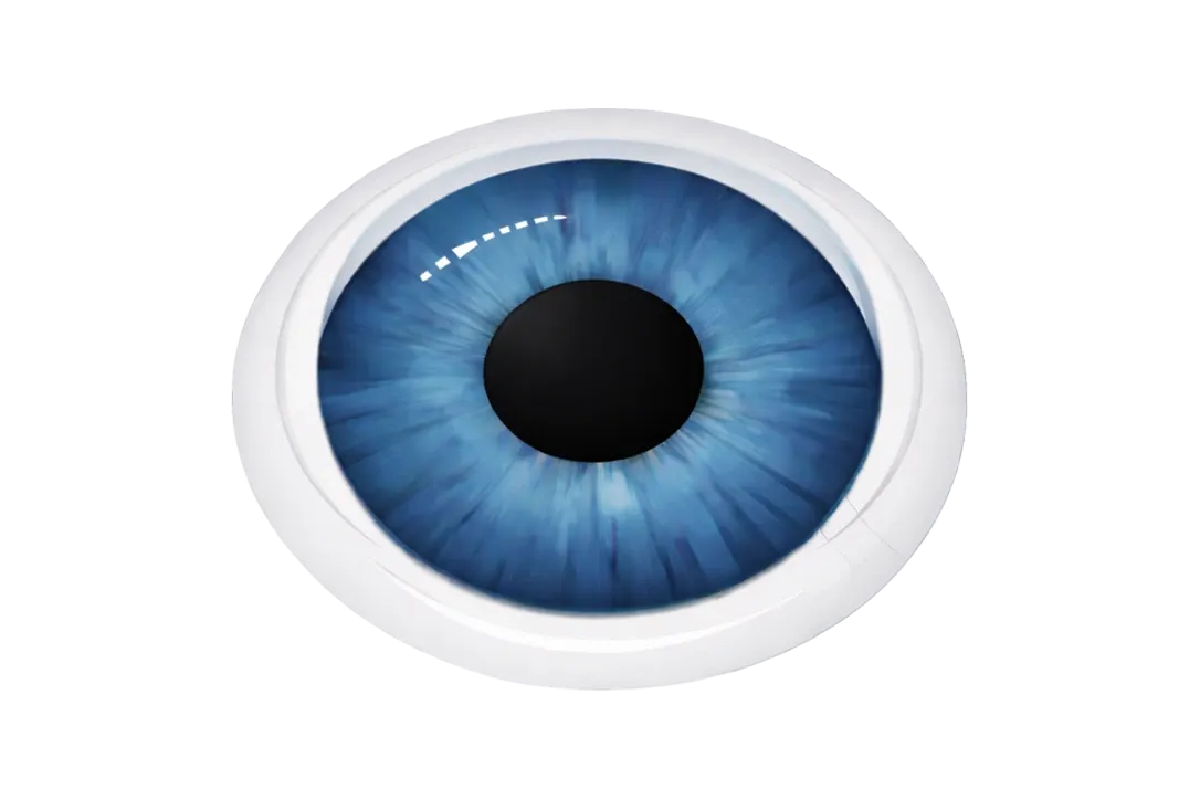 Skizze eines Auges zur Darstellung der SMILE pro Methode beim Augenlasern.