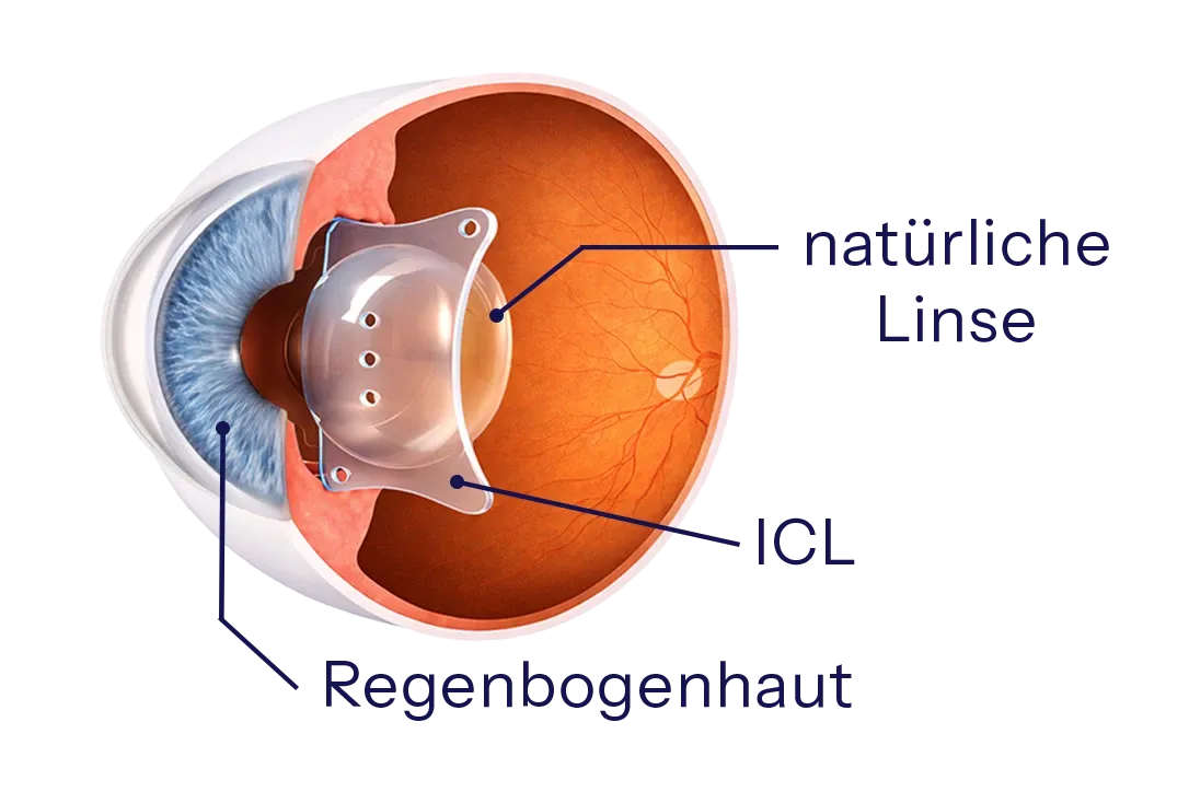Skizze eines Auges mit implantierter ICL vor der natürlichen Linse – Linsenimplantation zur Korrektur von Fehlsichtigkeiten.