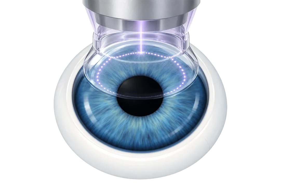 Image Illustration eines Auges bei der Femto-LASIK: Ein Femtosekunden-Laser erzeugt einen Flap in der Hornhaut.