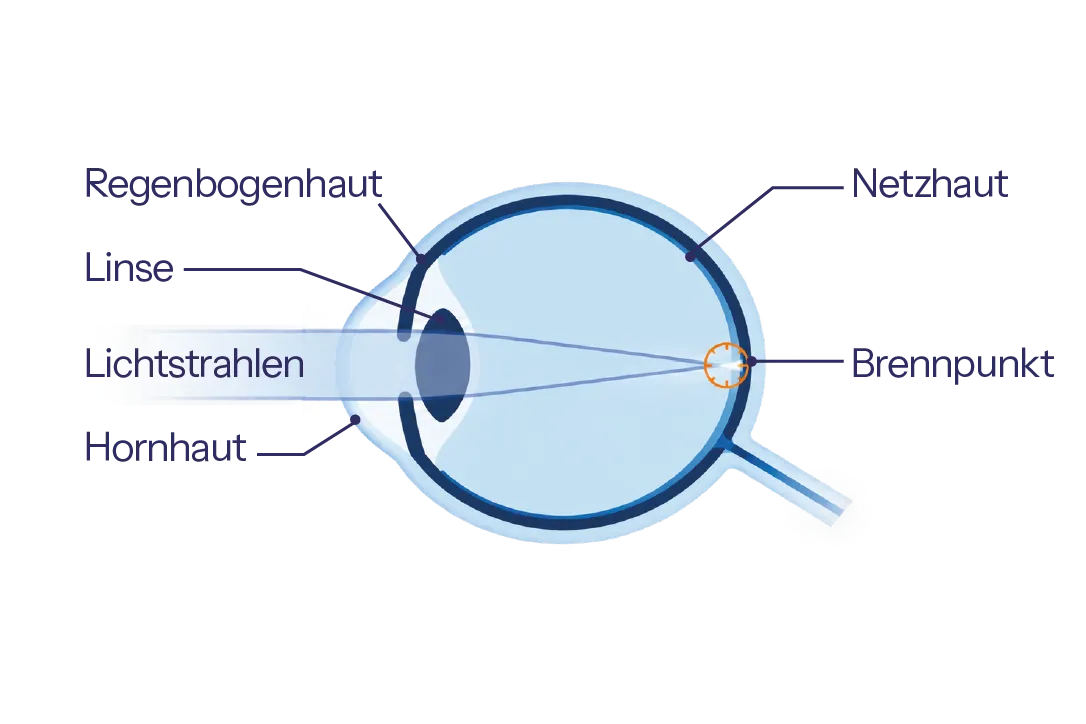 Skizze eines mit Augenlaser korrigierten kurzsichtigen Auges mit Brennpunkt auf der Netzhaut – Augen lasern bei Kurzsichtigkeit.