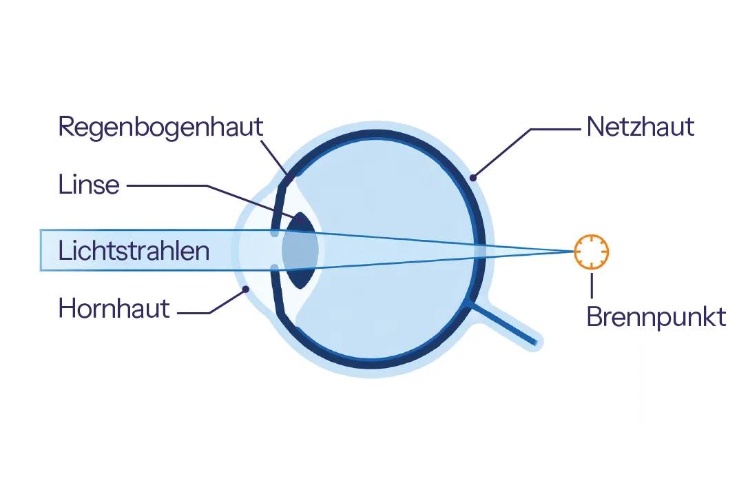 Schematische Darstellung der Weitsichtigkeit: Einfallende Lichtstrahlen bündeln sich erst hinter der Netzhaut. (KI-generiert)