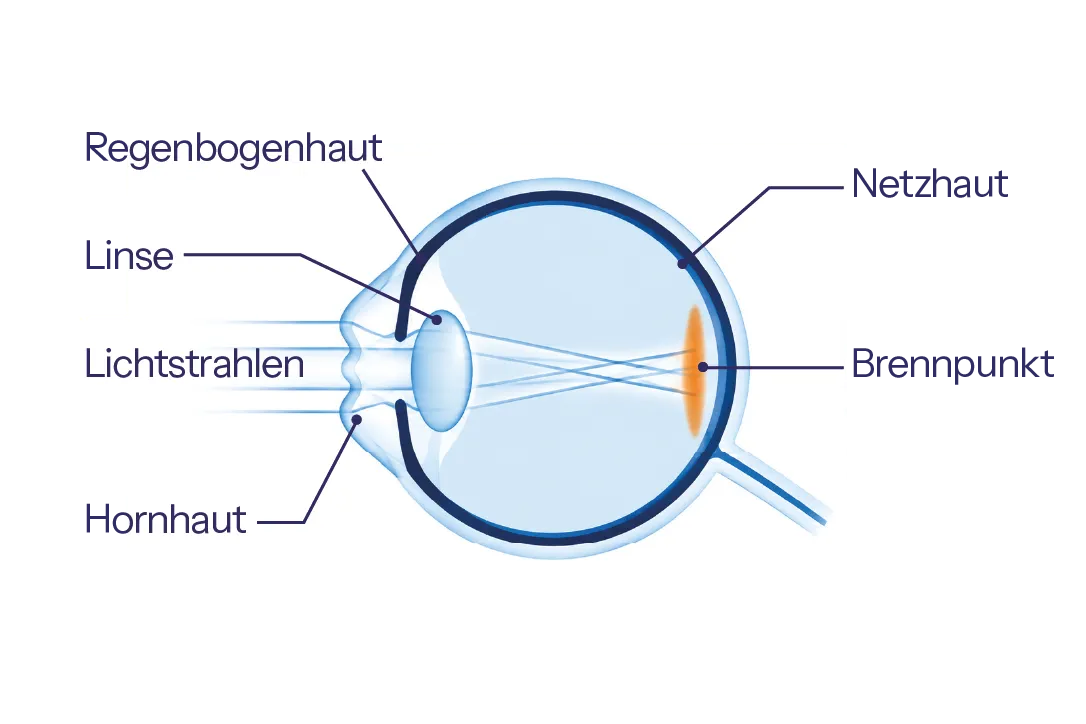 Skizze eines Auges mit ungleichmäßiger Lichtbrechung bei Hornhautverkrümmung.