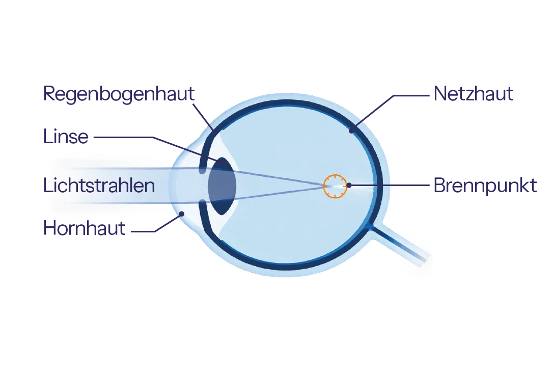 Skizze eines kurzsichtigen Auges mit Brennpunkt vor der Netzhaut – Augen lasern bei Kurzsichtigkeit.