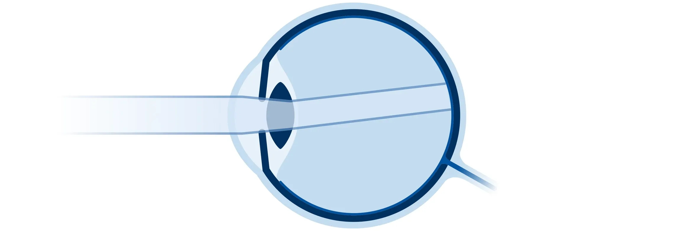 Schematische Darstellung eines Auges mit Hornhautverkrümmung (Astigmatismus). Die einfallenden Lichtstrahlen werden aufgrund der ungleichmäßig gekrümmten Hornhaut unterschiedlich gebrochen und nicht in einem gemeinsamen Brennpunkt auf der Netzhaut fokussiert. Dadurch entsteht ein unscharfer Seheindruck.