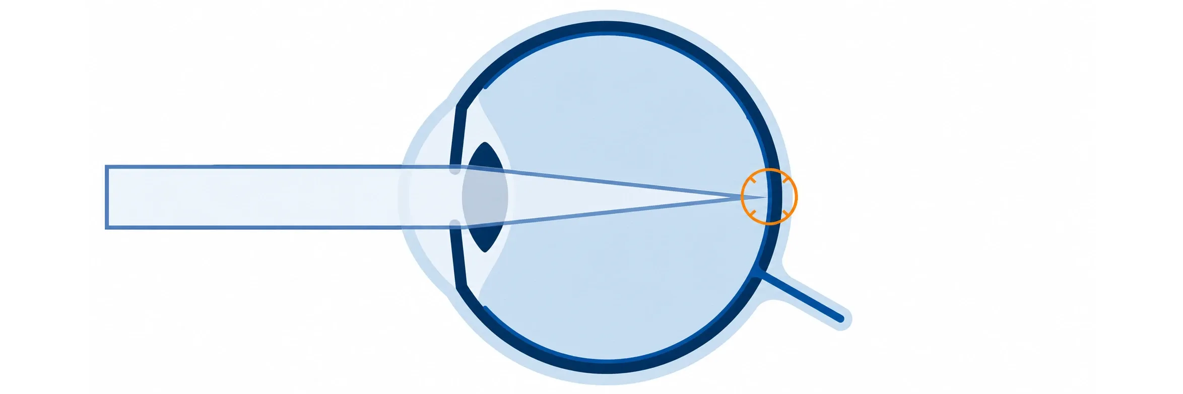 Schematische Darstellung eines normalsichtigen Auges. Die einfallenden Lichtstrahlen werden durch Hornhaut und Linse gebündelt und treffen in einem gemeinsamen Brennpunkt exakt auf der Netzhaut auf.