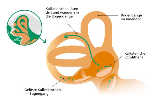 Infografik der Bogengänge zur Entstehung von gutartigem Lagerungsschwindel.