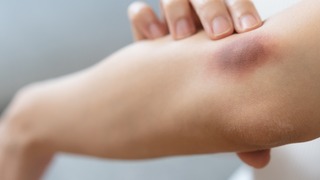 Frau mit Hämatom am Ellenbogen.