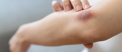 Frau mit Hämatom am Ellenbogen.