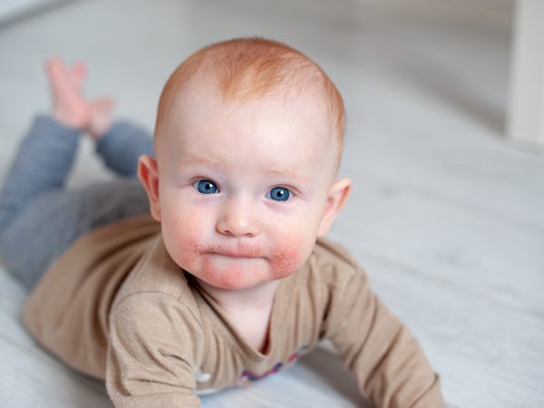 Baby mit Neurodermitis im Gesicht