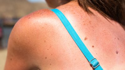 Frau im Bikini mit Sonnenbrand auf der Schulter und dem Rücken