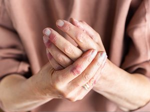 Zwei Hände mit Anzeichen von Neurodermitis