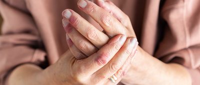 Zwei Hände mit Anzeichen von Neurodermitis