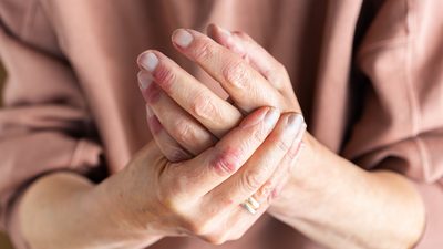 Zwei Hände mit Anzeichen von Neurodermitis