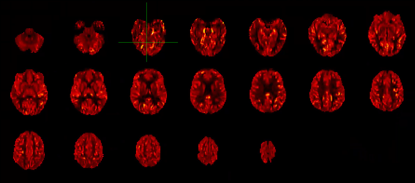 An image of blood perfusion in a healthy young adult acquired with UEA&rsquo;s MRI scanner
